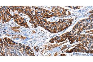 Immunohistochemistry of paraffin-embedded Human esophagus cancer tissue using ITGA7 Polyclonal Antibody at dilution 1:35 (ITGA7 antibody)