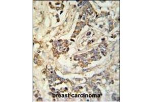 MR Antibody (N-term) 9980a IHC analysis in formalin fixed and paraffin embedded breast carcinoma followed by peroxidase conjugation of the secondary antibody and DAB staining.