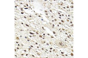 Immunohistochemistry of paraffin-embedded human liver cancer using Glucocorticoid Receptor Rabbit pAb (ABIN3023090, ABIN3023091, ABIN3023092, ABIN1513281 and ABIN6219384) at dilution of 1:100 (40x lens). (Glucocorticoid Receptor antibody  (AA 1-280))