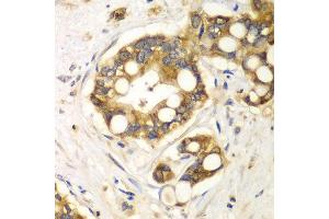 Immunohistochemistry of paraffin-embedded human liver cancer using RPH3A antibody at dilution of 1:100 (x40 lens). (RPH3A antibody)