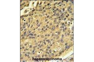 CTSH Antibody (N-term) (ABIN391569 and ABIN2841506) IHC analysis in formalin fixed and paraffin embedded human hepatocarcinoma followed by peroxidase conjugation of the secondary antibody and DAB staining. (Cathepsin H antibody  (N-Term))