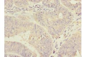 Immunohistochemistry of paraffin-embedded human endometrial cancer using ABIN7150598 at dilution of 1:100 (Ribophorin II antibody  (AA 360-540))