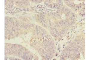 Immunohistochemistry of paraffin-embedded human endometrial cancer using ABIN7150598 at dilution of 1:100
