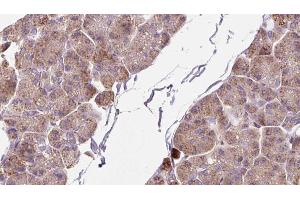 ABIN6273262 at 1/100 staining Human pancreas cancer tissue by IHC-P. (DHX58 antibody  (Internal Region))