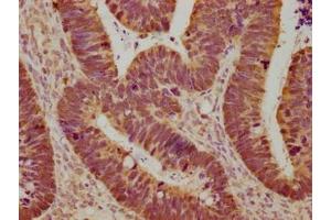 Immunohistochemical of paraffin-embedded human ovarian cancer using ABIN7153439 at dilution of 1:100 (Galectin 3 antibody)