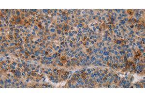 Immunohistochemistry of paraffin-embedded Human liver cancer using AMBP Polyclonal Antibody at dilution of 1:55 (AMBP antibody)
