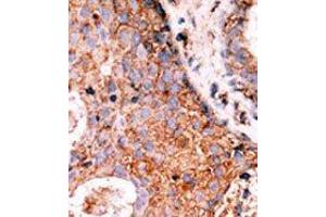 Formalin-fixed and paraffin-embedded human cancer tissue reacted with the primary antibody, which was peroxidase-conjugated to the secondary antibody, followed by DAB staining. (LMTK2 antibody  (N-Term))