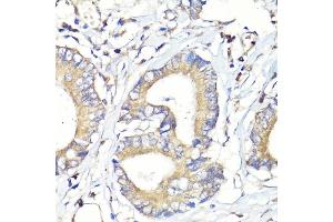 Immunohistochemistry of paraffin-embedded human colon carcinoma using HB-EGF antibody (ABIN7267617) at dilution of 1:100 (40x lens). (HBEGF antibody  (AA 20-160))