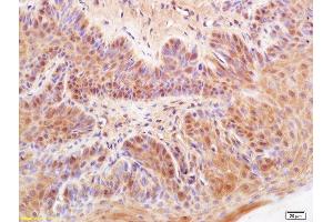 Formalin-fixed and paraffin embedded rat buccal mucosa cancer labeled with Anti-DKK3 Polyclonal Antibody, Unconjugated (ABIN749123) at 1:200 followed by conjugation to the secondary antibody and DAB staining (DKK3 antibody  (AA 31-130))