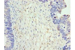 Immunohistochemistry of paraffin-embedded human ovarian cancer using ABIN7161852 at dilution of 1:100