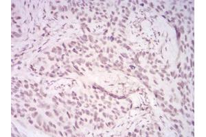 Immunohistochemical analysis of paraffin-embedded cervical cancer tissues using DDX39B mouse mAb with DAB staining. (DDX39B antibody  (AA 1-250))
