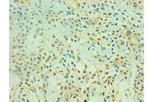 Immunohistochemistry of paraffin-embedded human breast cancer using ABIN7160859 at dilution of 1:100 (SIRT3 antibody  (AA 20-130))