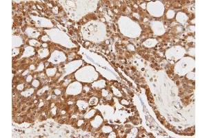 IHC-P Image Immunohistochemical analysis of paraffin-embedded OVCA xenograft, using 14-3-3 sigma, antibody at 1:100 dilution. (14-3-3 sigma/SFN antibody)