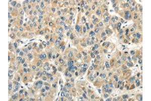 The image on the left is immunohistochemistry of paraffin-embedded Human liver cancer tissue using ABIN7190243(CHGB Antibody) at dilution 1/30, on the right is treated with synthetic peptide. (CHGB antibody)