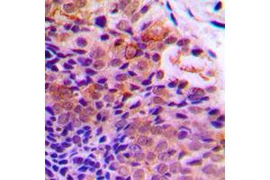 Immunohistochemical analysis of PDCD4 (pS457) staining in human prostate cancer formalin fixed paraffin embedded tissue section.