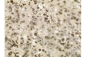 ABIN6262509 and ABIN6276320 at 1/100 staining human melanoma by IHC-P.