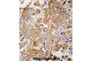 Formalin-fixed and paraffin-embedded human lung carcinomareacted with LECT1 polyclonal antibody , which was peroxidase-conjugated to the secondary antibody, followed by AEC staining.