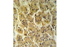 Immunohistochemistryanalysis in formalin fixed and paraffin embedded hepatocarcinoma reacted with NDUFS2 Antibody (Center) followed which was peroxidase conjugated to the secondary antibody and followed by DAB staining.