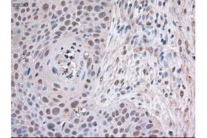 Immunohistochemical staining of paraffin-embedded Adenocarcinoma of breast using anti-Trim33 (ABIN2452534) mouse monoclonal antibody (TRIM33 antibody  (AA 887-1046))