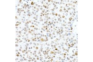 Immunohistochemistry of paraffin-embedded human liver cancer using Phospho-Histone H3. (Histone H3.3 antibody  (pSer31))