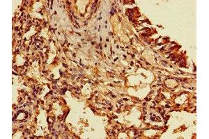 Immunohistochemistry of paraffin-embedded human lung cancer using ABIN7153207 at dilution of 1:100 (TIGAR antibody  (AA 24-188))