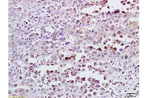 Formalin-fixed and paraffin embedded mouse lymphoma tissue labeled with Anti-CDK4 Polyclonal Antibody (ABIN671166), Unconjugated at 1:300, followed by conjugation to the secondary antibody and DAB staining (CDK4 antibody  (AA 241-303))