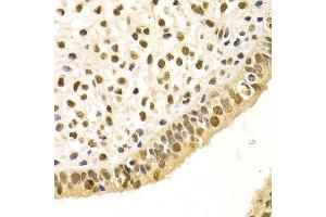 Immunohistochemistry of paraffin-embedded human uterine cancer using DDB1 Antibody. (DDB1 antibody)