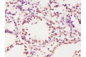 Formalin-fixed and paraffin embedded human lung labeled with Anti-ECT2 Polyclonal Antibody, Unconjugated  at 1:300 followed by conjugation to the secondary antibody and DAB staining. (ECT2 antibody  (AA 781-883))