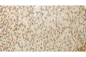 Immunohistochemistry of paraffin-embedded Human cervical cancer using MYSM1 Polyclonal Antibody at dilution of 1:60 (MYSM1 antibody)