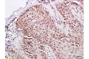 Formalin-fixed and paraffin-embedded human skin psoriasis labeled with Rabbit Anti- PPARrPolyclonal Antibody, unconjugated  (ABIN669711)  at 1: 200 followed by incubation with conjugated secondary antibody and DAB staining (PPARG antibody  (AA 101-200))