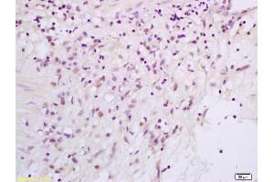 Formalin-fixed and paraffin embedded human gastric carcinoma labeled with Rabbit Anti phospho-Bcl-xL/BCL2L1(Thr115) Polyclonal Antibody, Unconjugated (ABIN756817) at 1:200 followed by conjugation to the secondary antibody and DAB staining (BCL2L1 antibody  (pThr115))