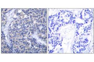 Immunohistochemical analysis of paraffin-embedded human breast carcinoma tissue, using Zap-70 (Ab-319) antibody (E021173). (ZAP70 antibody)