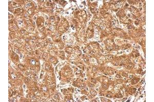 IHC-P Image HACL1 antibody detects HACL1 protein at cytosol on human hepatoma by immunohistochemical analysis. (HACL1 antibody  (C-Term))
