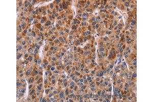 Immunohistochemistry of Human thyroid cancer using SELPLG Polyclonal Antibody at dilution of 1:50 (SELPLG antibody)