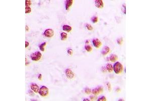 Immunohistochemical analysis of Artemis (pS516) staining in human lung cancer formalin fixed paraffin embedded tissue section. (DCLRE1C antibody  (pSer516))