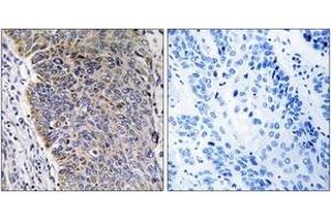 Immunohistochemistry analysis of paraffin-embedded human lung carcinoma tissue, using MGST3 Antibody. (MGST3 antibody  (AA 8-57))