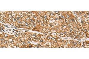 Immunohistochemistry of paraffin-embedded Human liver cancer tissue using DCAF12 Polyclonal Antibody at dilution of 1:65(x200)