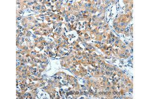 Immunohistochemistry of Human lung cancer using ADRA1B Polyclonal Antibody at dilution of 1:25
