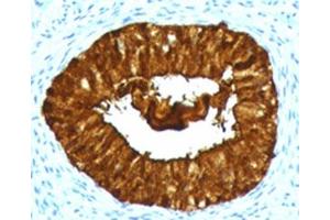 IHC testing of FFPE human cervical carcinoma with MAML3 antibody (clone MMLP3-1). (MAML3 antibody)