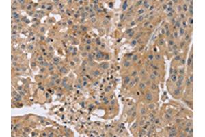 The image on the left is immunohistochemistry of paraffin-embedded Human breast cancer tissue using ABIN7191184(KCNJ15 Antibody) at dilution 1/35, on the right is treated with synthetic peptide. (KCNJ15 antibody)