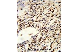 Formalin-fixed and paraffin-embedded human lung carcinoma reacted with FLCN Antibody (Center), which was peroxidase-conjugated to the secondary antibody, followed by DAB staining. (FLCN antibody  (AA 325-354))