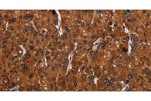 Immunohistochemistry of paraffin-embedded Human liver cancer tissue using RTN4R Polyclonal Antibody at dilution 1:50 (RTN4R antibody)