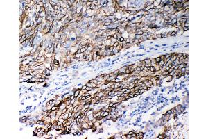 Anti-Stefin B antibody, IHC(P) IHC(P): Human Lung Cancer Tissue (CSTB antibody  (Middle Region))
