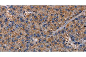 Immunohistochemistry of paraffin-embedded Human liver cancer using NUP62 Polyclonal Antibody at dilution of 1:40 (NUP62 antibody)