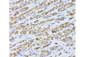 Immunohistochemistry of paraffin-embedded Human colon carcinoma using CCDC92 Polyclonal Antibody at dilution of 1:100 (40x lens).