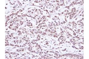 IHC-P Image Immunohistochemical analysis of paraffin-embedded A549 Xenograft, using SMC1A, antibody at 1:100 dilution. (SMC1A antibody  (N-Term))