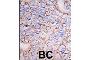 Formalin-fixed and paraffin-embedded human breast carcinoma tissue reacted with ERK8 antibody (N-term), which was peroxidase-conjugated to the secondary antibody, followed by DAB staining. (MAPK15 antibody  (N-Term))