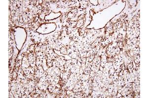 Paraffin embedded sections of human renal cell carcinoma tissue were initrocelluloseubated with anti-human Clusterin (1:100) for 2 hours at room temperature. (Clusterin antibody  (AA 1-333))