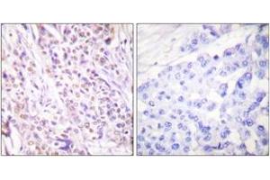 Immunohistochemistry analysis of paraffin-embedded human breast carcinoma tissue, using RAD17 (Ab-645) Antibody. (RAD17 antibody  (AA 621-670))