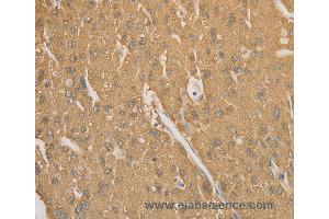 Immunohistochemistry of Human gastric cancer using CD40 Polyclonal Antibody at dilution of 1:70